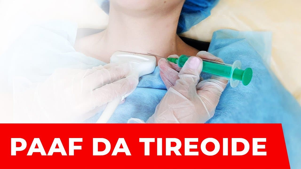 Resultado da PAAF - Punção da tireoide e classificação de Bethesda