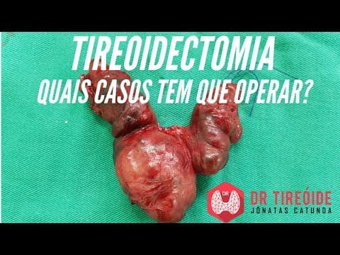 Quem precisa fazer a tireoidectomia? | Dr Jônatas Catunda