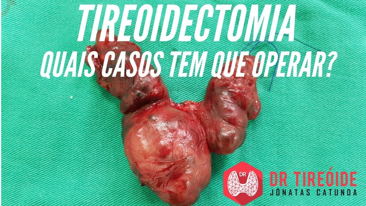 Quem precisa fazer a tireoidectomia? | Dr Jônatas Catunda