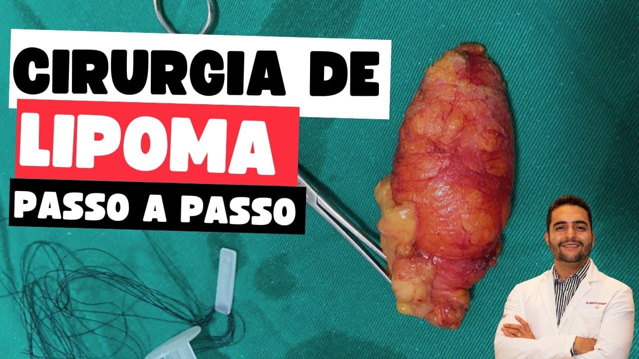Cirurgia de lipoma no pescoço filmada passo a passo, completa