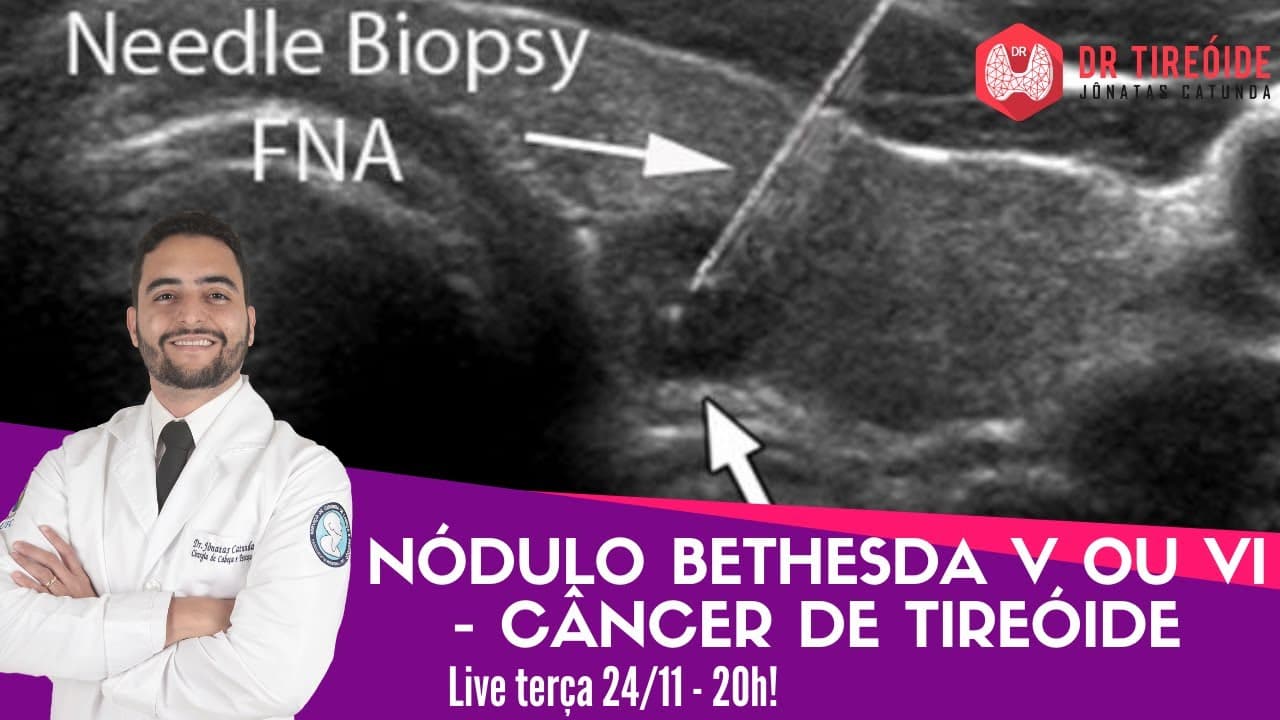 Nódulo Bethesda V e VI - Câncer de tireóide - Dr Tireóide responde