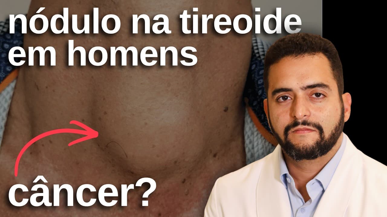 Nódulo na Tireoide em Homens Tem Mais Risco de Ser Câncer? A Verdade que Poucos Falam