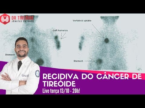 Recidiva do câncer de tireóide - LIVE Dr Tireóide responde