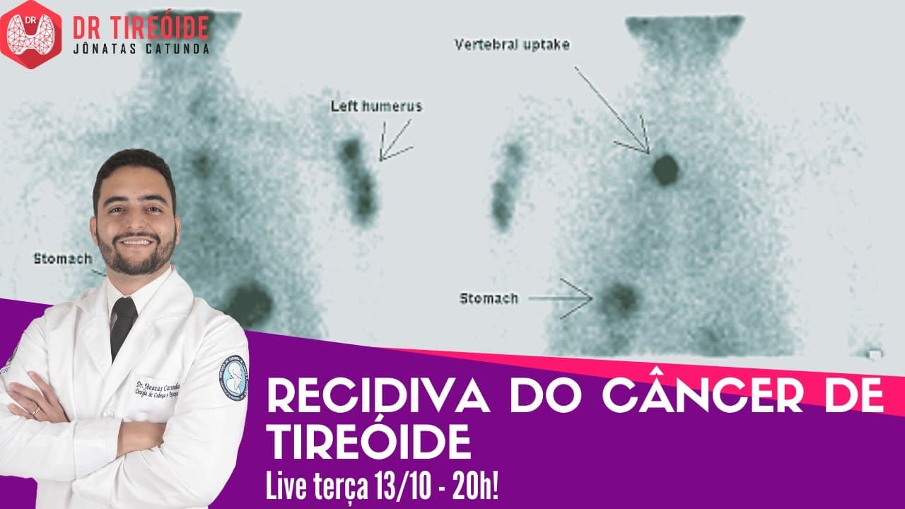 Recidiva do câncer de tireóide - LIVE Dr Tireóide responde