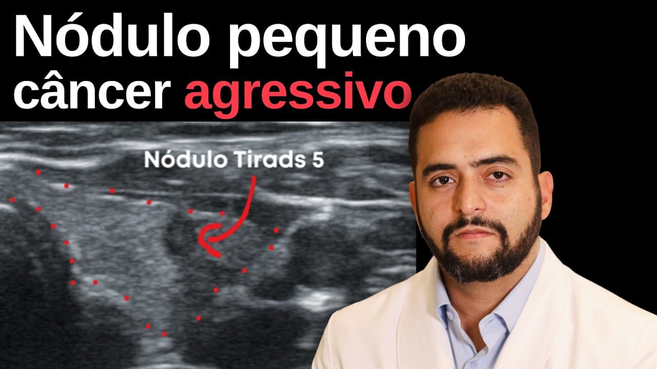 O erro de achar que todo câncer pequeno da tireoide é tranquilo