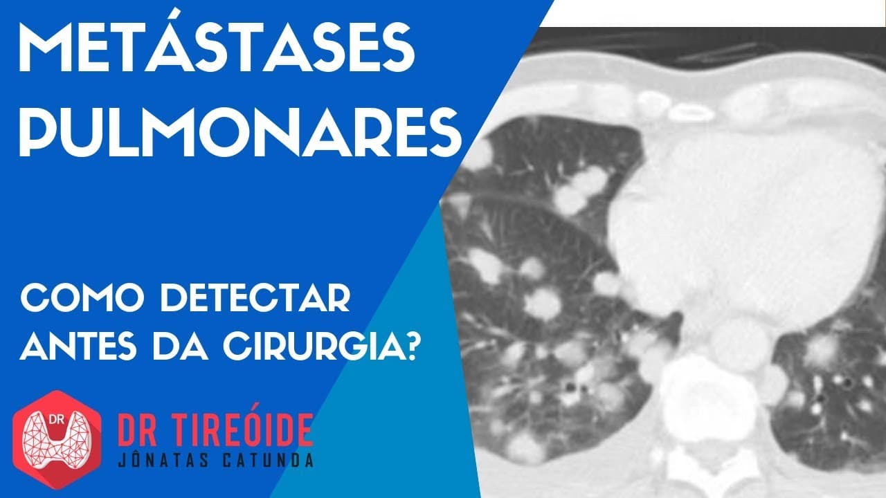 Metástases pulmonares do câncer de tireóide - Como detectar antes da cirurgia?