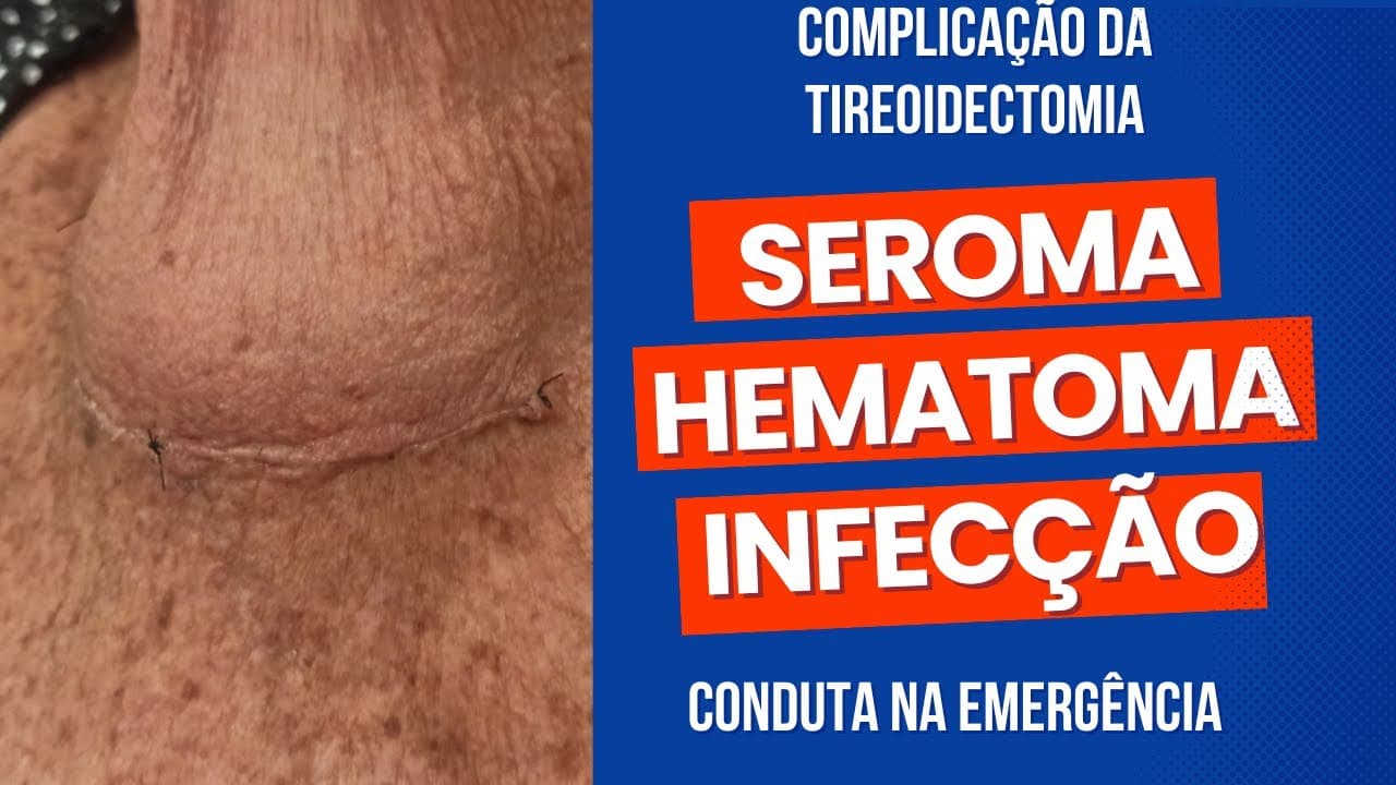 Complicações da tireoidectomia na EMERGÊNCIA - Seroma / Hematoma / Infecção
