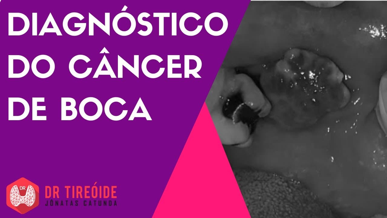 Diagnóstico do câncer de boca - Dr Jônatas Catunda