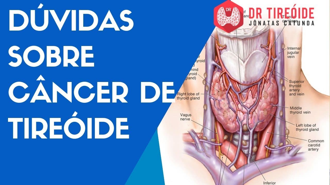 Dúvidas sobre câncer de tireóide - iodoterapia, agressividade | Dr Tireóide Responde