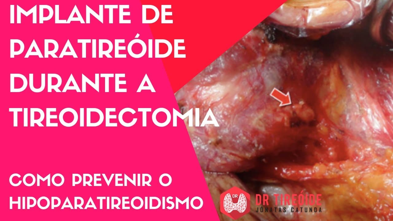 Implante de paratireóide - evitar o hipoparatireoidismo - Cirurgia | Dr Jônatas Catunda