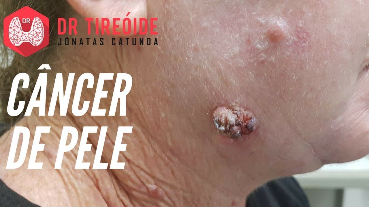 Câncer de Pele | Dr Jônatas Catunda