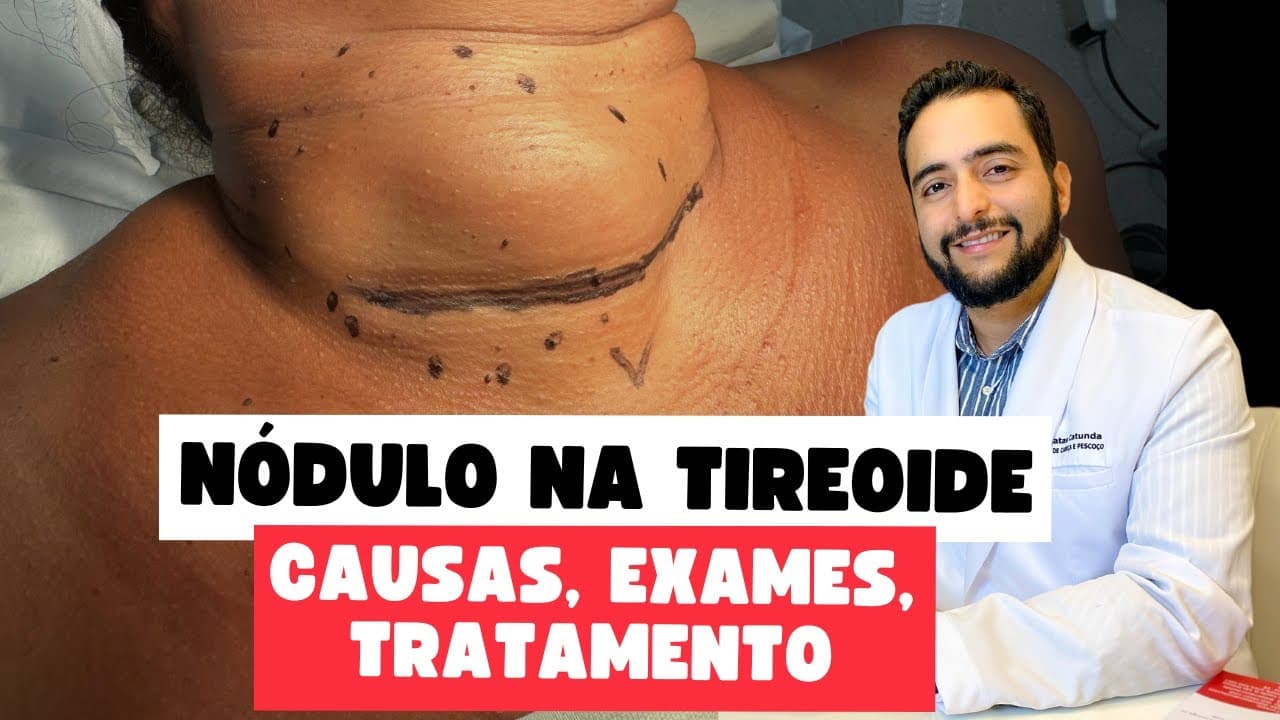 Nódulos na Tireoide: O Que Você Precisa Saber