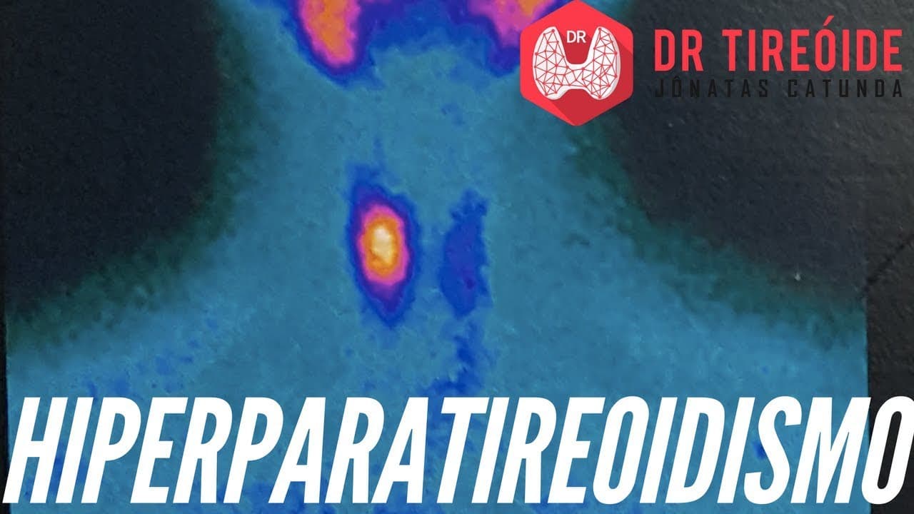 Hiperparatireoidismo - Você conhece essa doença? | Dr Jônatas Catunda