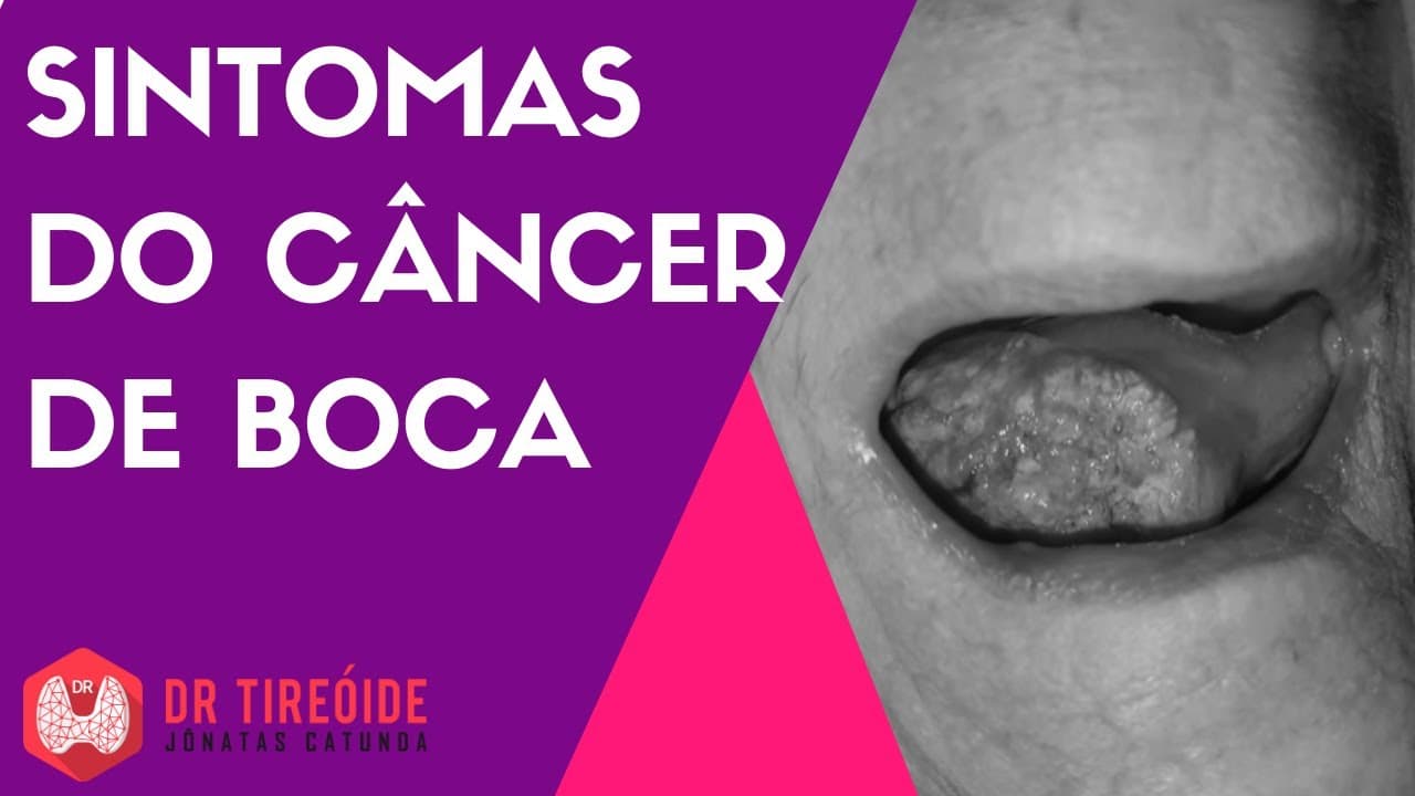 Sintomas do câncer de boca - Dr Jônatas Catunda