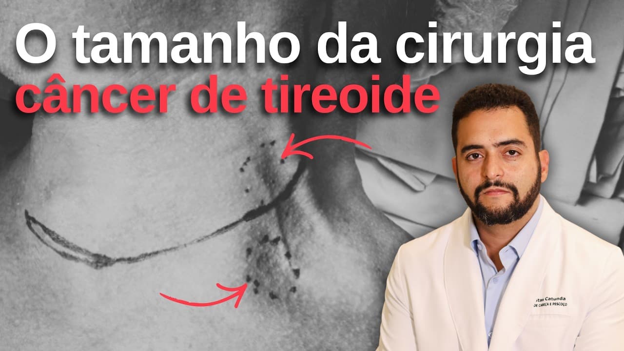É assim que eu explico a extensão da cirurgia no câncer de tireoide | Dr. Jônatas Catunda