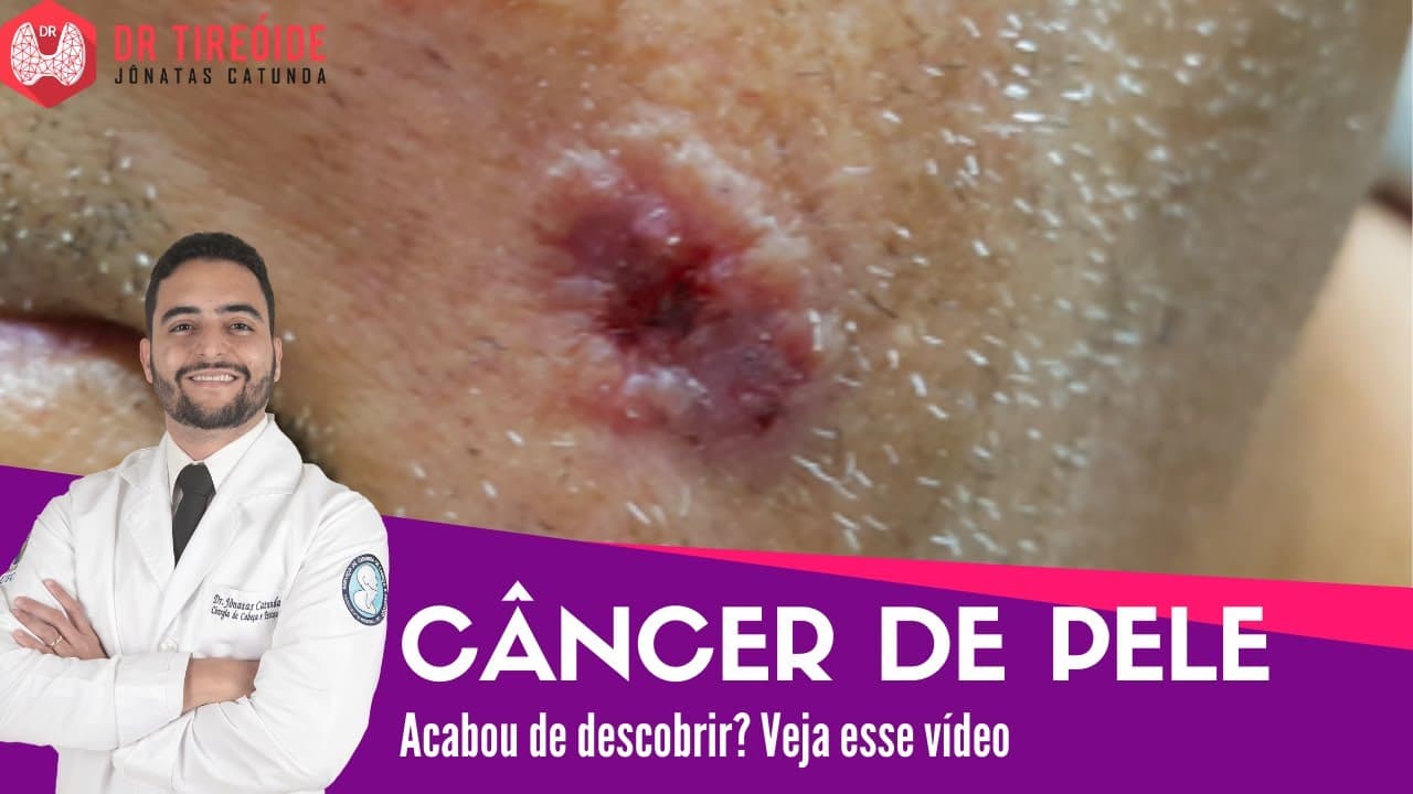 Câncer de pele - Vídeo para quem acabou de descobrir! | Dr Jônatas Catunda