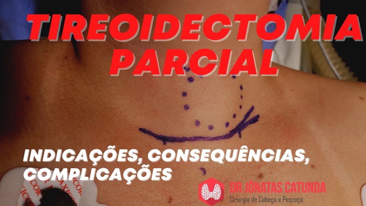 Tireoidectomia parcial - indicações, consequências, complicações