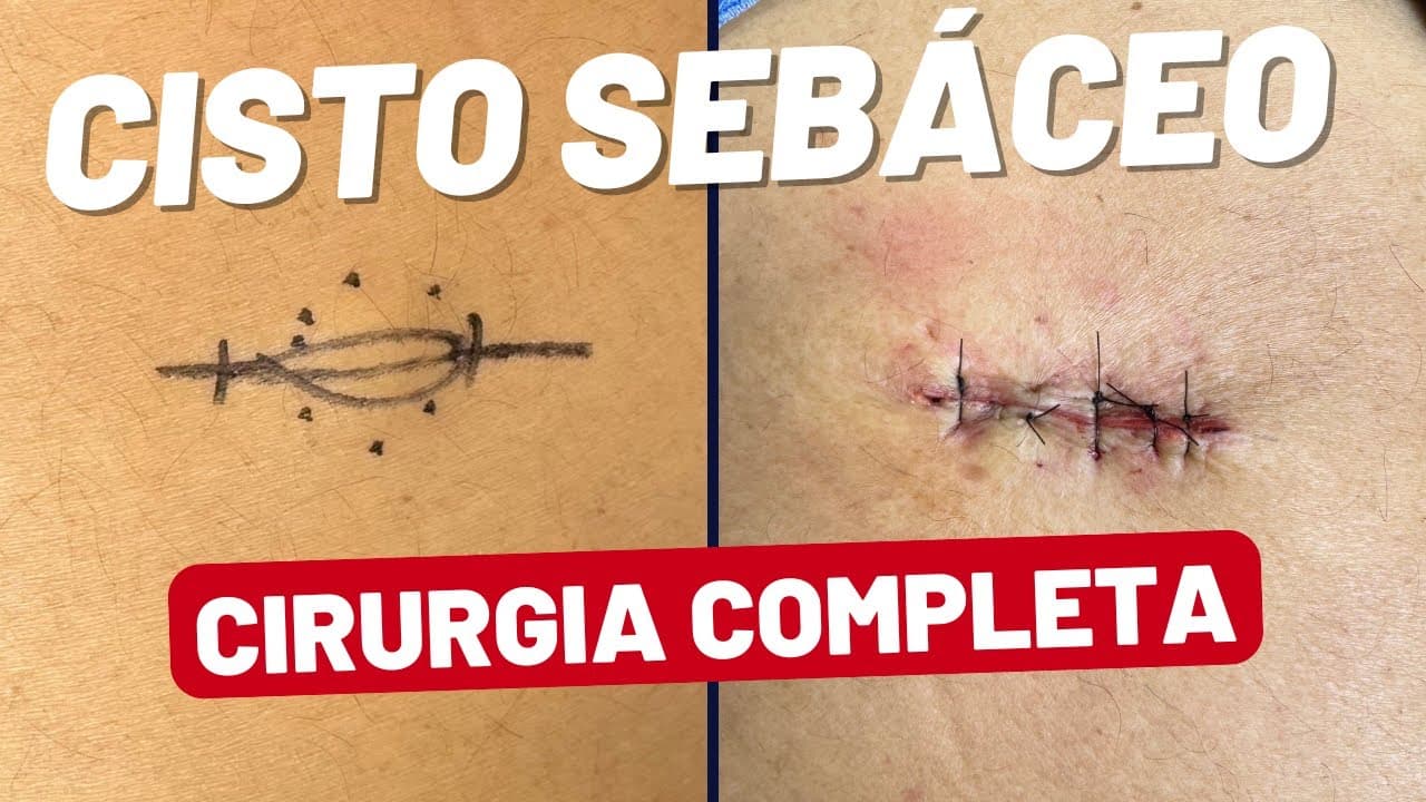 Cisto Sebáceo: Cirurgia Real Filmada passo a passo!