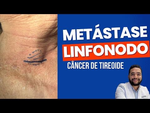 Metástase para os linfonodos - câncer de tireoide