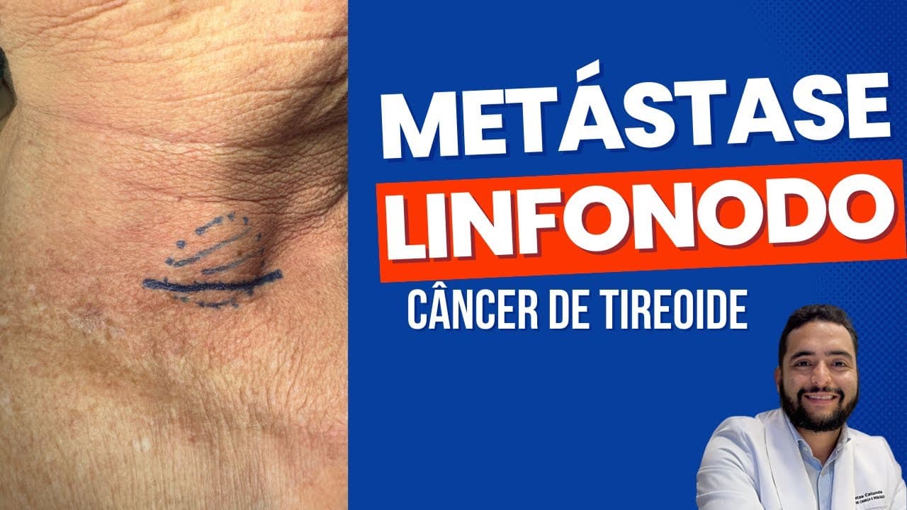 Metástase para os linfonodos - câncer de tireoide