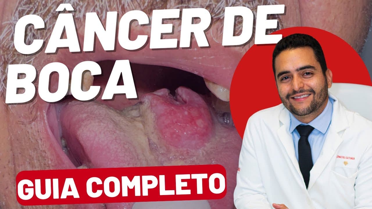 Câncer de Boca: Fotos de Casos, Sintomas, Diagnóstico, Tratamento