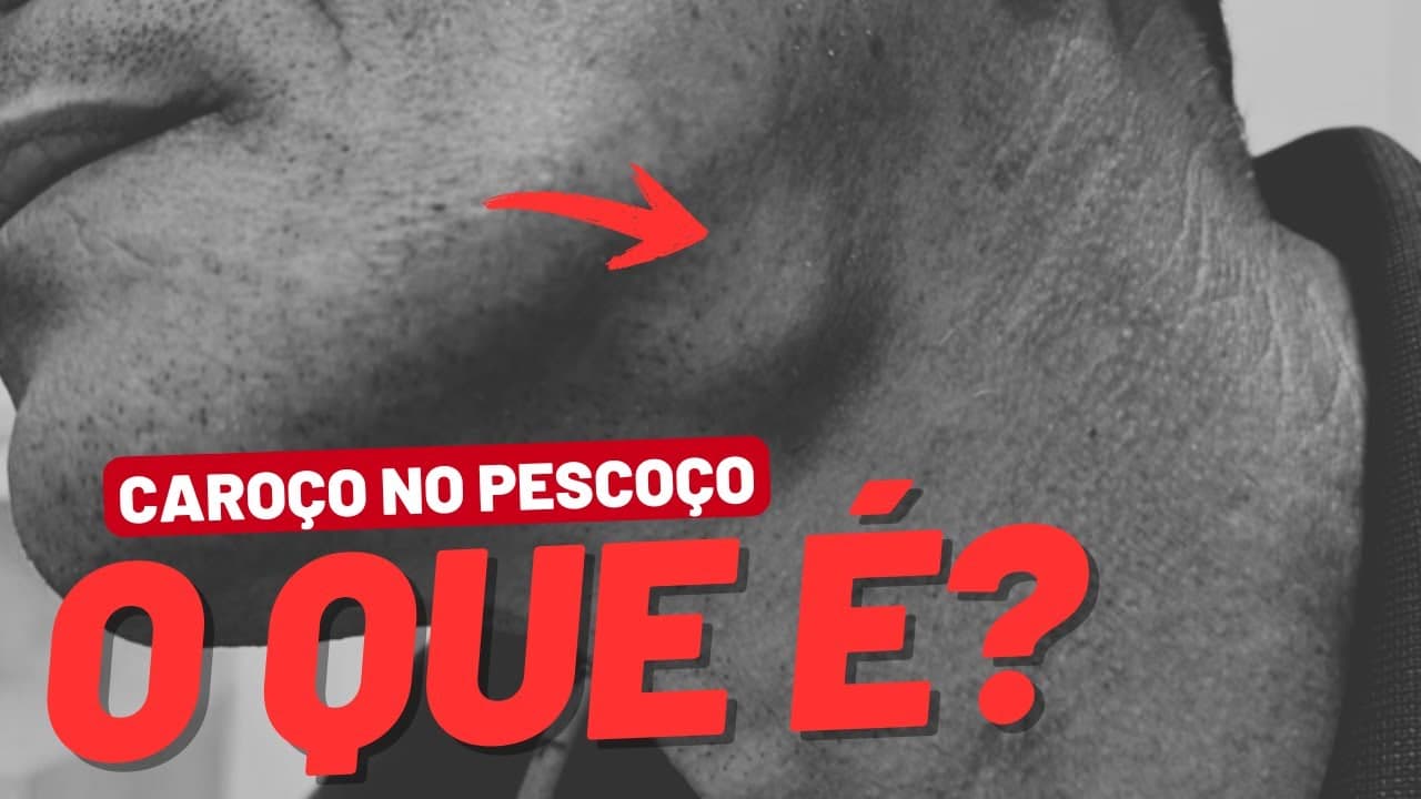 Caroço no pescoço: íngua, tireoide ou câncer?
