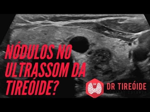 Ultrassom da tireóide - Saiba como avaliar os nódulos! | Dr Jônatas Catunda