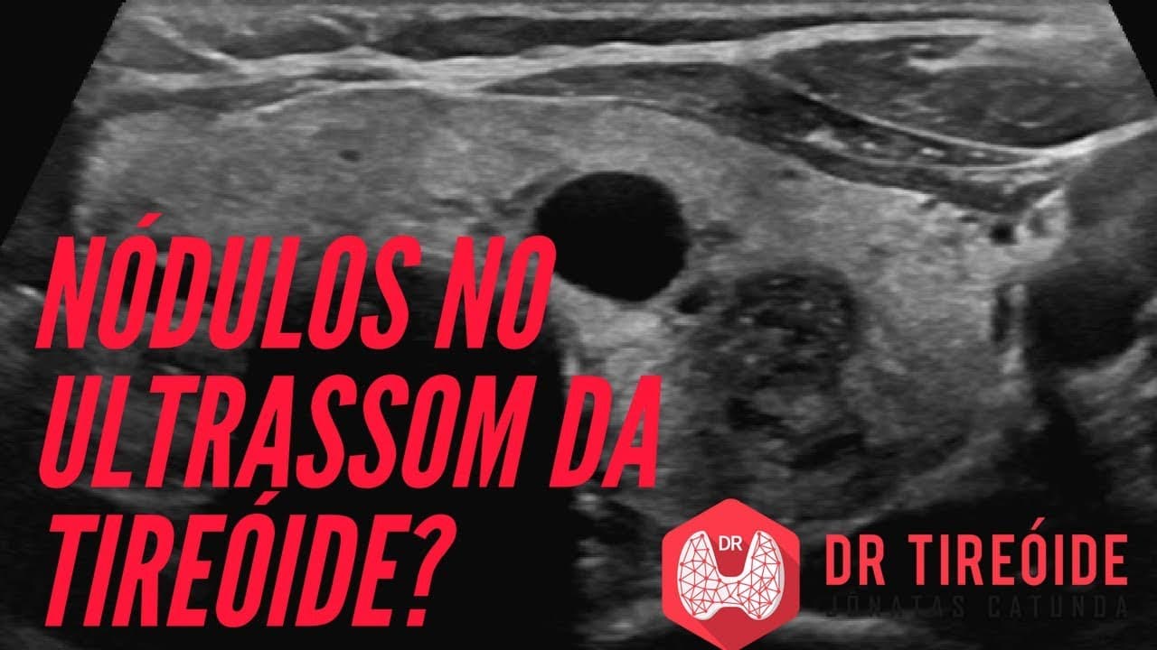 Ultrassom da tireóide - Saiba como avaliar os nódulos! | Dr Jônatas Catunda