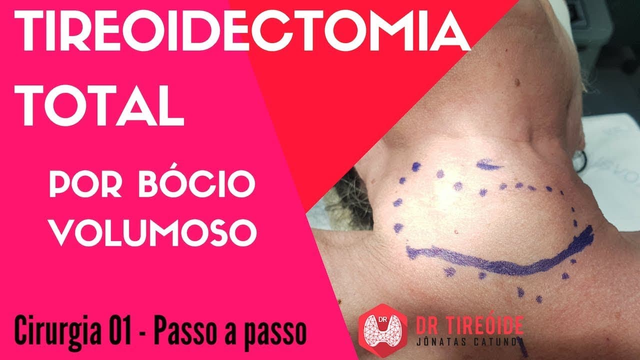 Tireoidectomia total - Cirurgia Passo a passo | Dr Jônatas Catunda