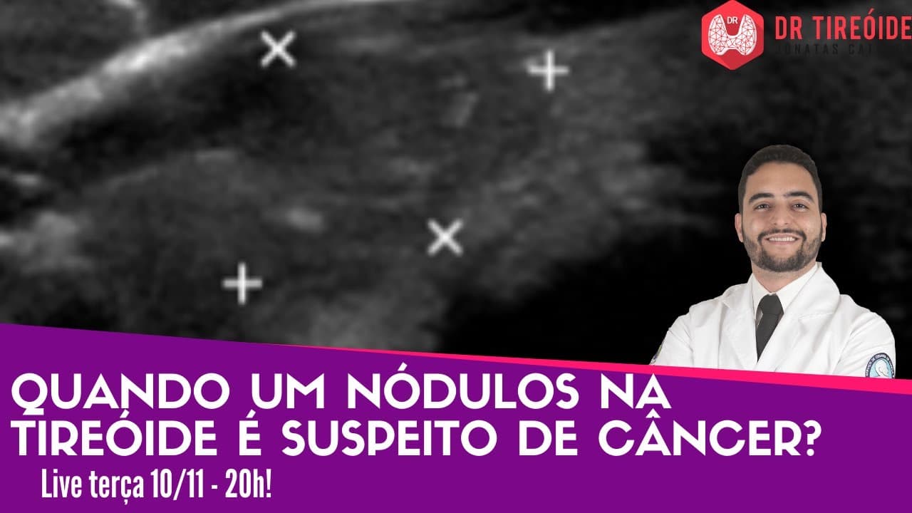 Quando um nódulo na tireóide é suspeito de câncer? Dr Tireóide responde