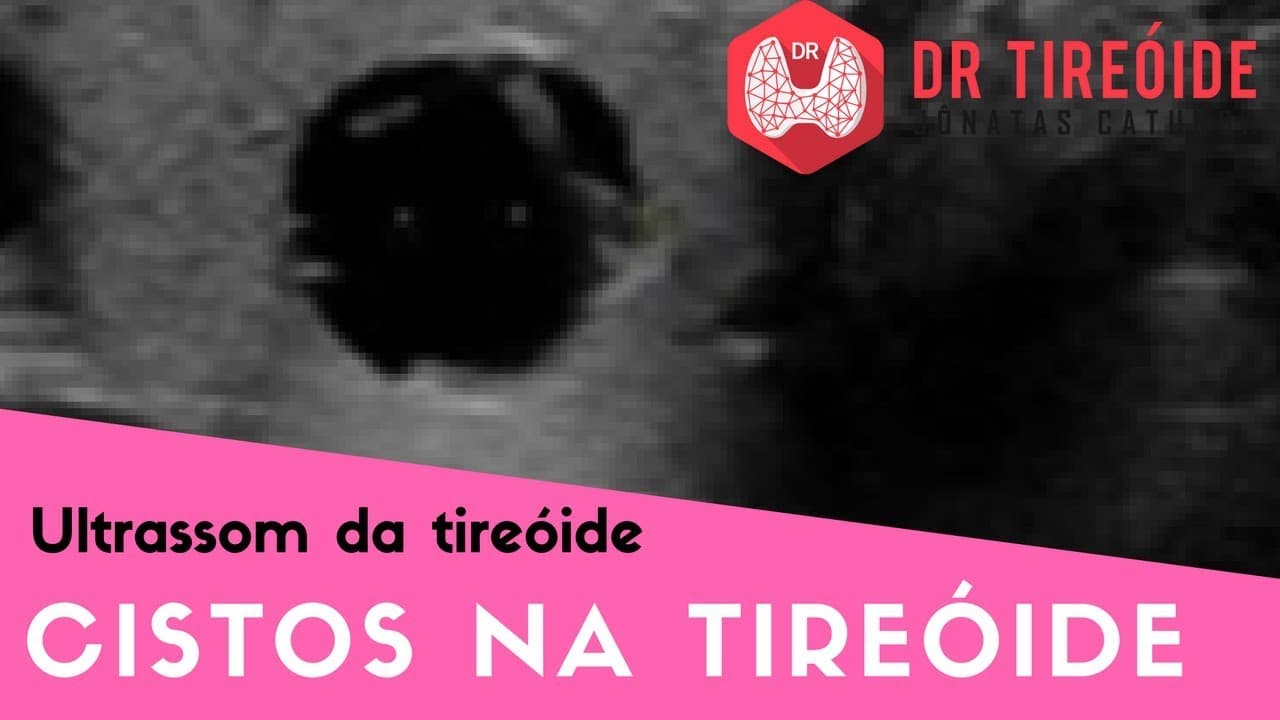 Ultrassom da tireóide - Cisto na tireóide é perigoso? | Dr Jônatas Catunda