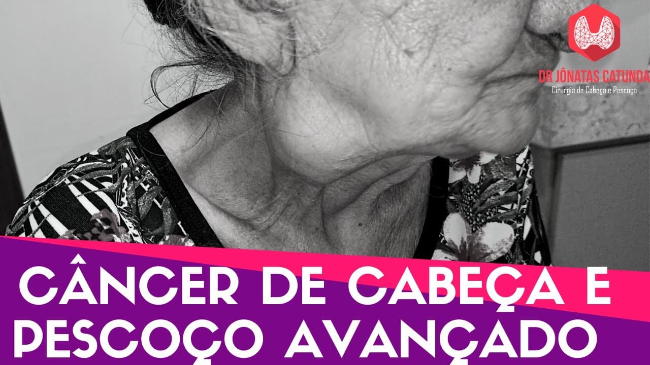 Câncer de cabeça e pescoço avançado - Informações importantes