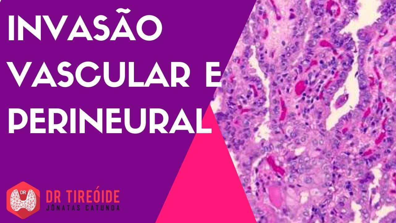 Invasão vascular e perineural - câncer de tireóide