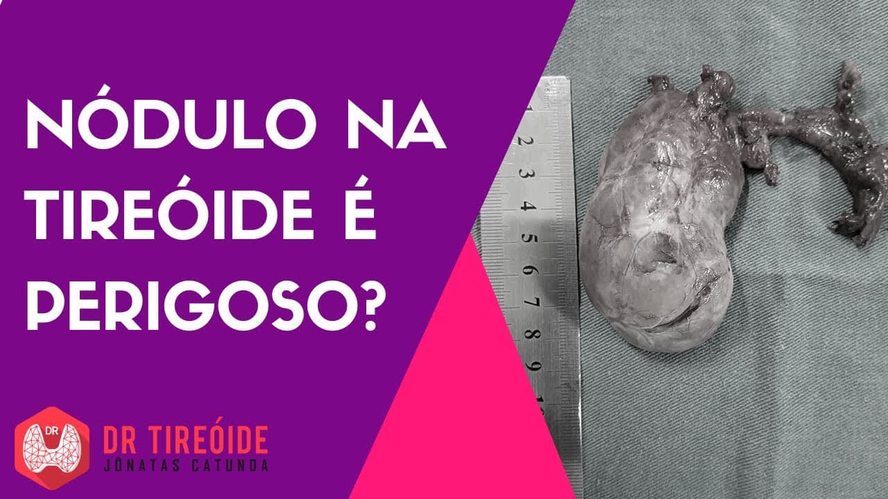 Nódulo na tireóide é perigoso? | Dr Jônatas Catunda
