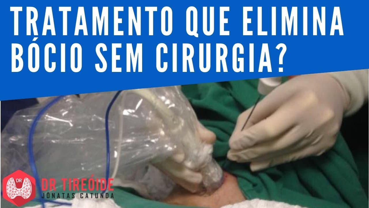 Tratamento que elimina bócio sem cirurgia? | Dr Tireóide Responde