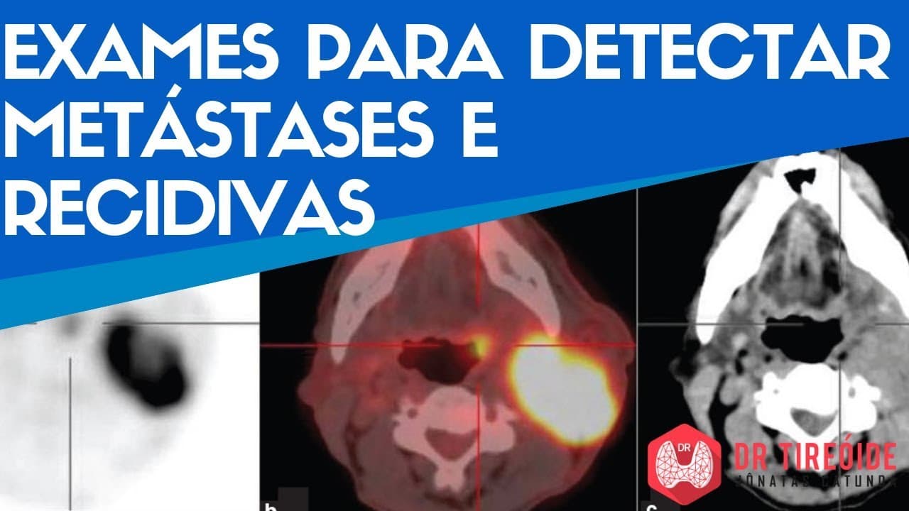 Exames para detectar metástases e recidivas | Dr Tireóide Responde