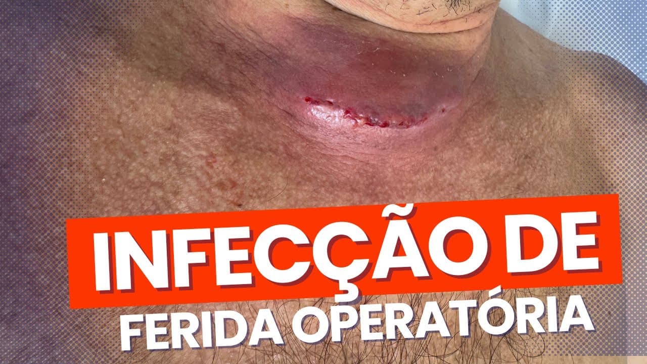Infecção de ferida operatória do pescoço - tireoidectomia