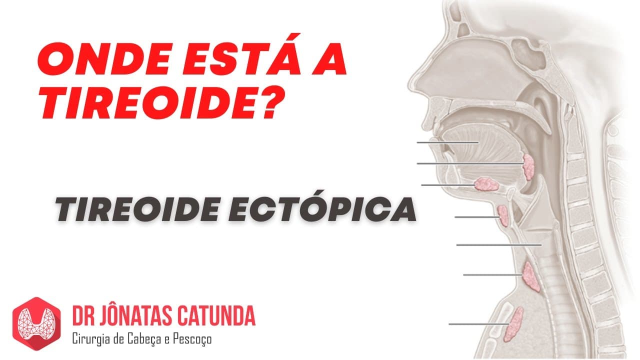 Caso atípico - Não encontrou a tireoide no pescoço