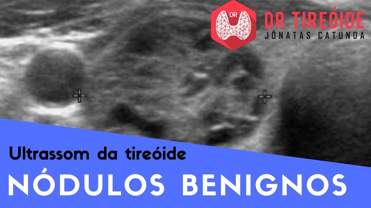 Ultrassom da tireóide - Nódulos benignos! | Dr Jônatas Catunda