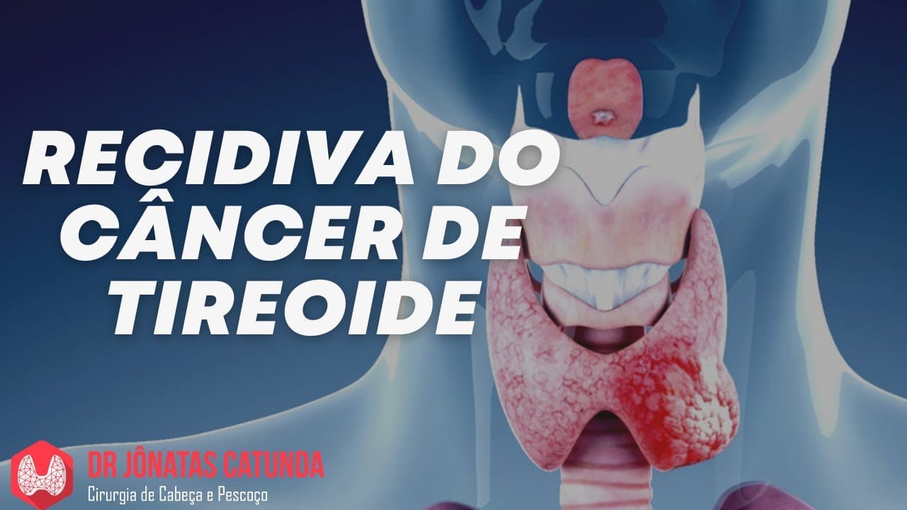Recidiva do câncer de tireoide - próximos passos