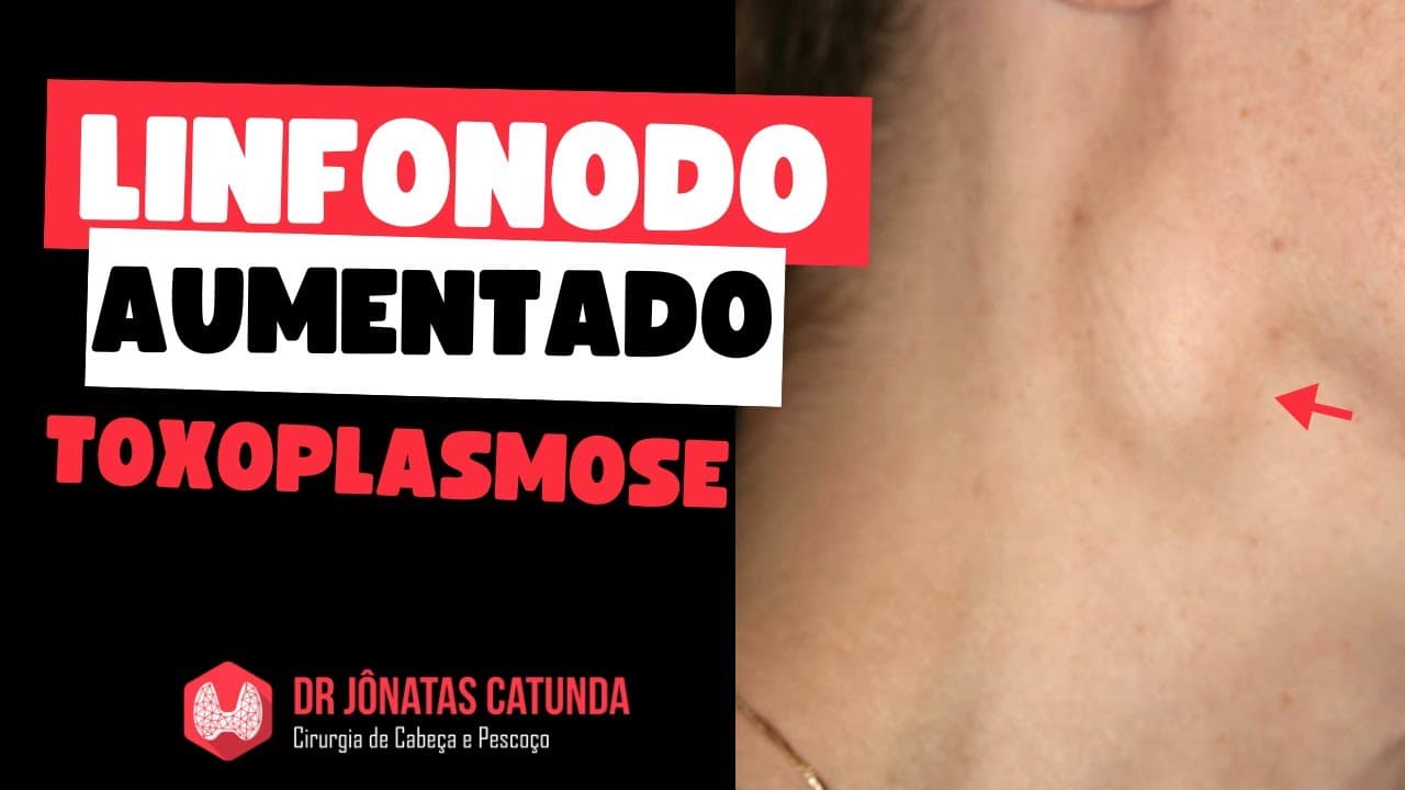 Linfonodo no pescoço aumentado - toxoplasmose
