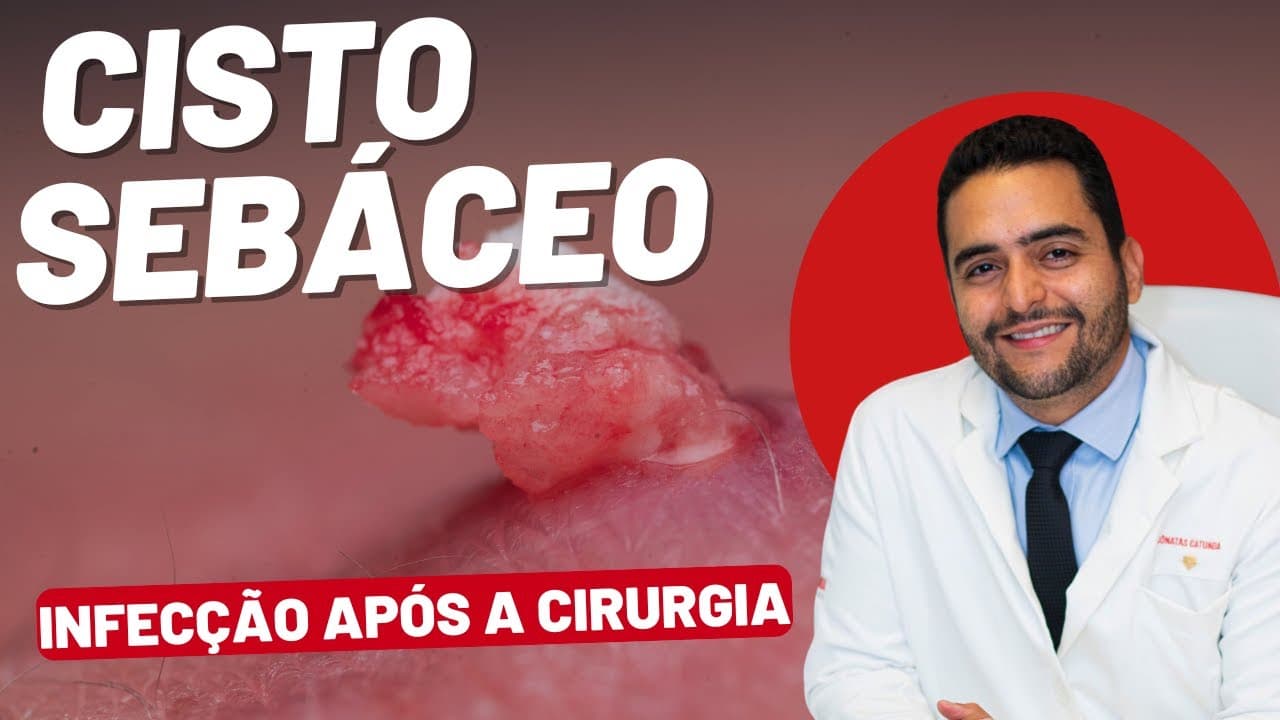 Infecção após cirurgia de cisto sebáceo: sinais