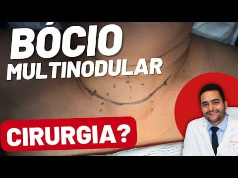 Quais casos de bócio tem indicação de cirurgia?