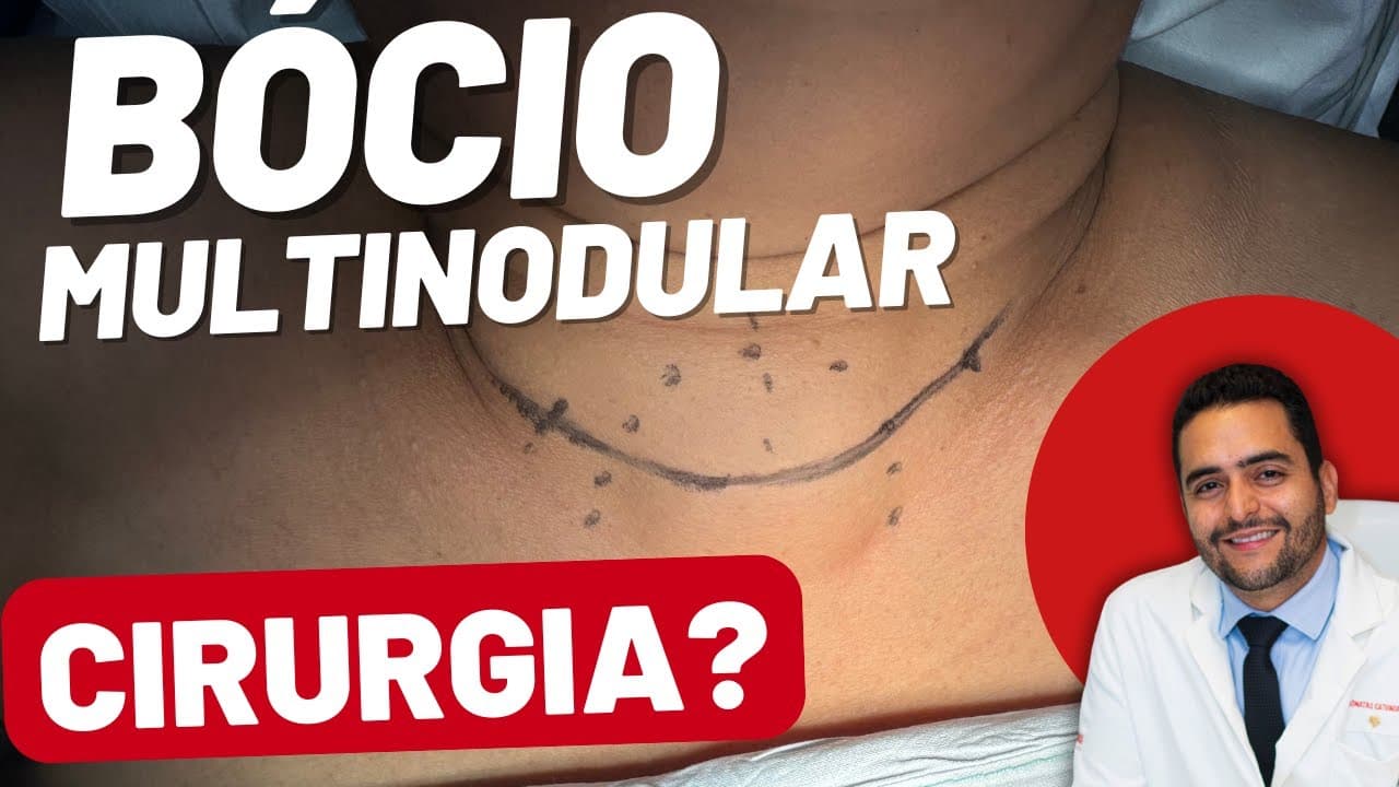 Quais casos de bócio tem indicação de cirurgia?