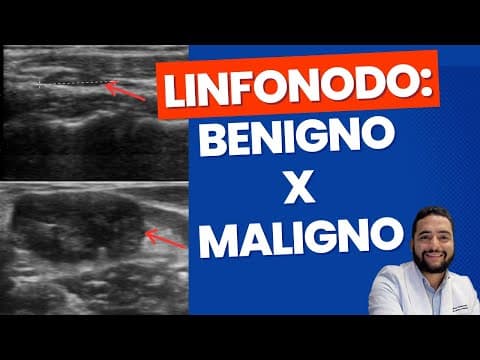 Linfonodo benigno X maligno