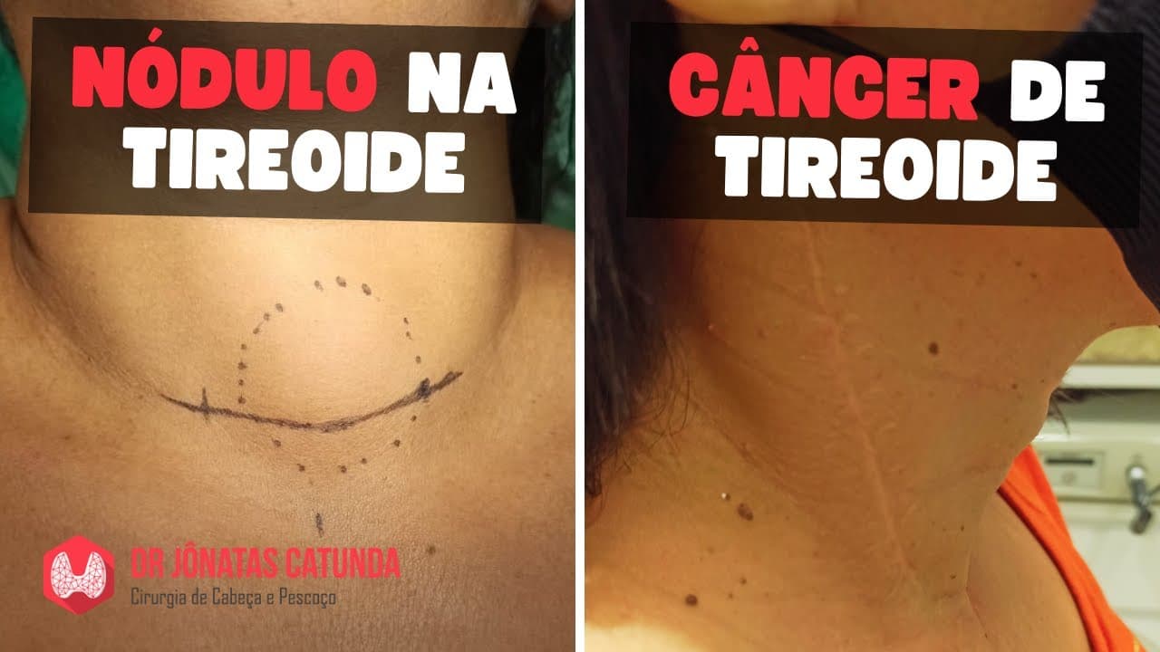 Nódulo na tireóide X Câncer de tireoide: entenda a diferença