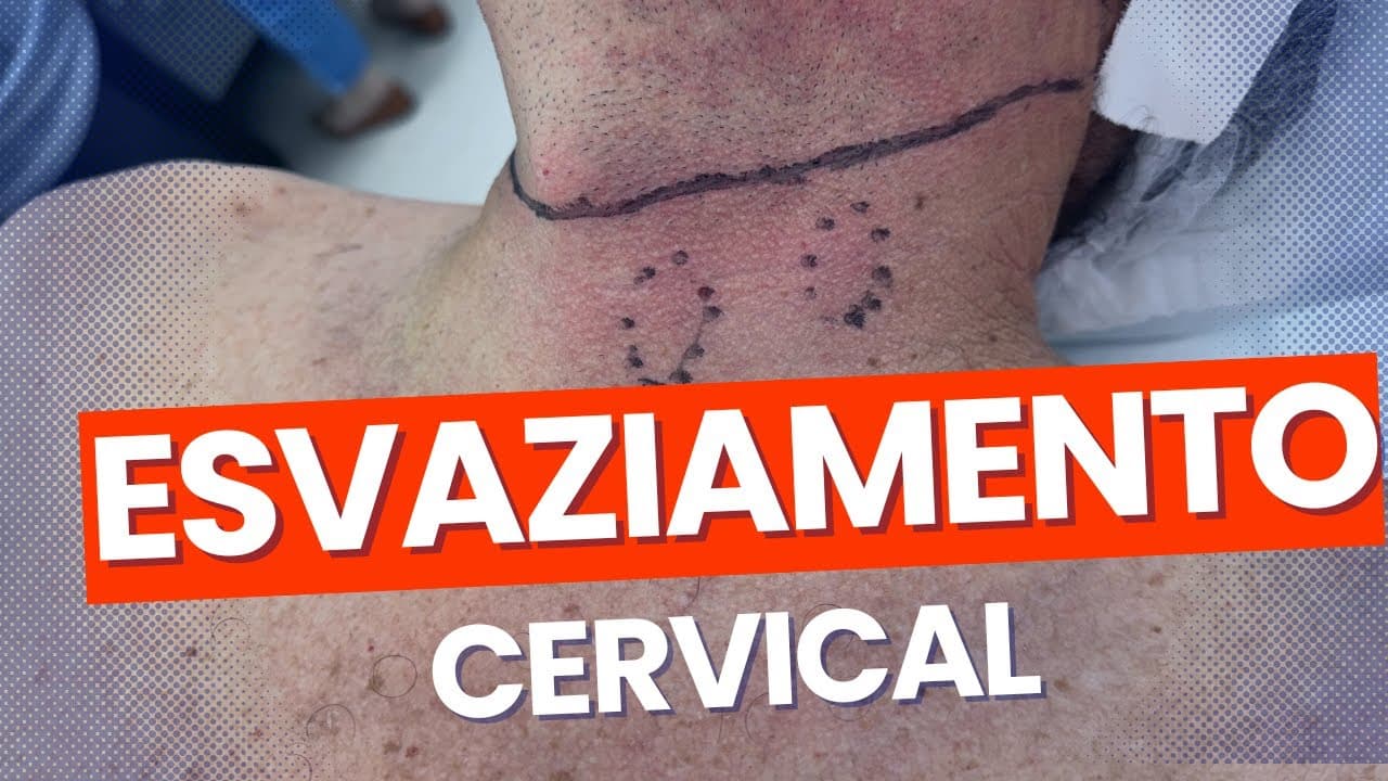 Esvaziamento cervical no câncer de tireoide - indicações, riscos, complicações, recuperação!
