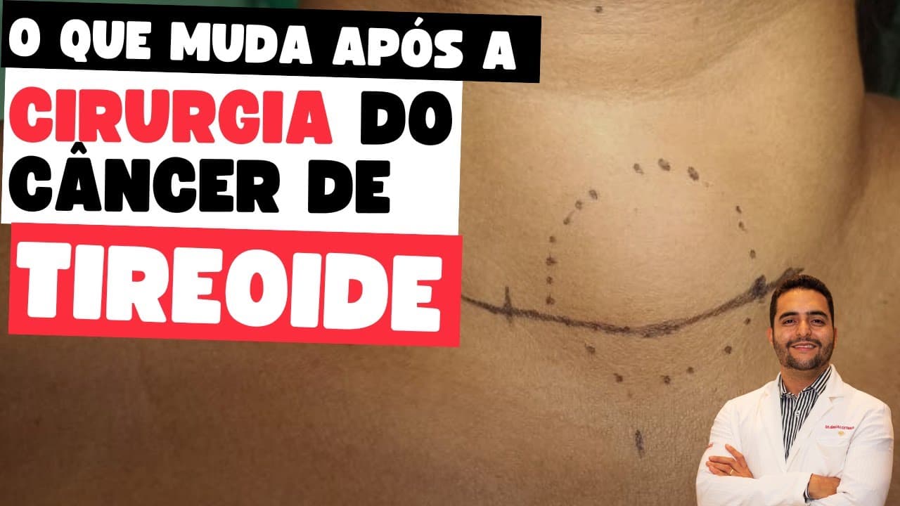 Vida após a cirurgia para o câncer de tireoide: mudanças, cuidados e expectativas