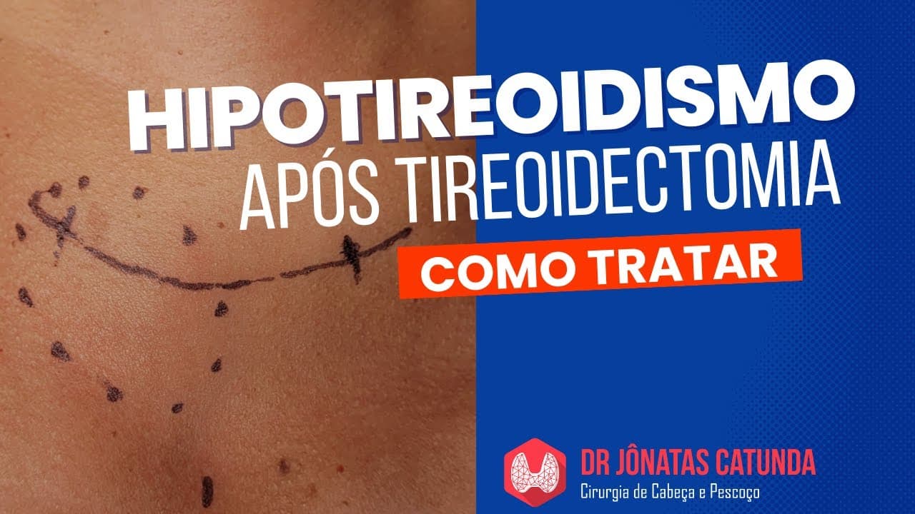 Vida Após a Tireoidectomia Total: Enfrentando o Hipotireoidismo