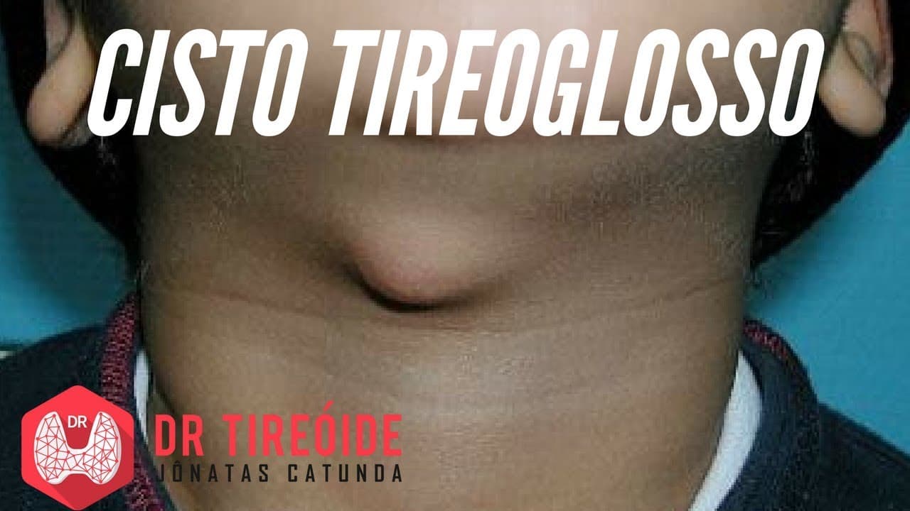 Cisto tireoglosso - doença que pode aparecer em crianças e adultos! | Dr Jônatas Catunda